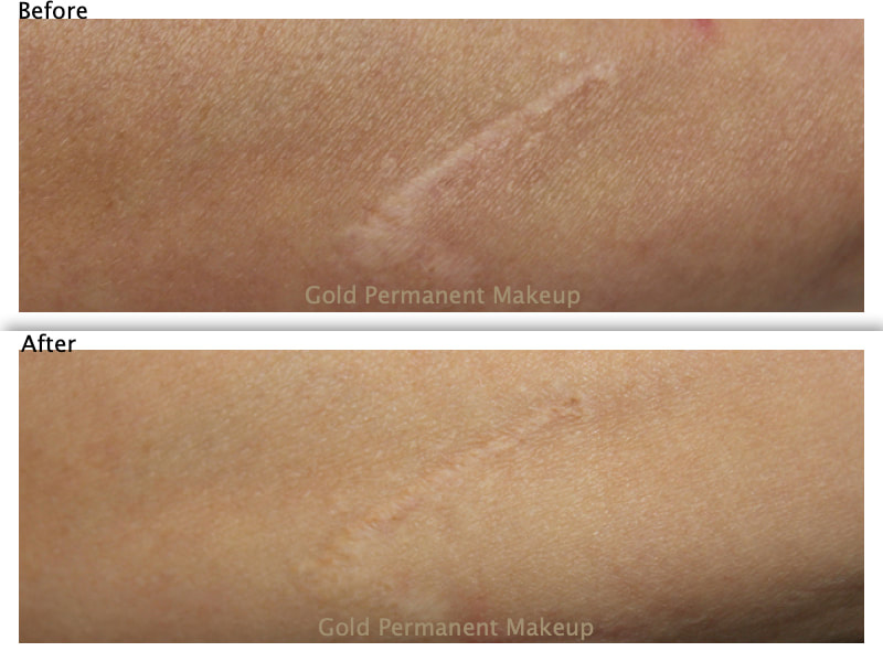 Scar Treatment by MicroArt Semi Permanent Makeup Camouflages Scars
